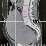 肿瘤直径超20cm 湖南省妇幼保健院拆“弹”专家拆除巨大宫颈肌瘤