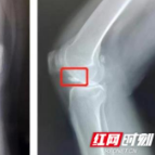 膝盖突然疼痛、卡壳 小心是“关节鼠”在作怪！