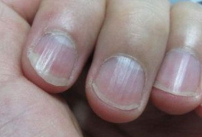 指甲盖上起竖纹、白斑是“死亡信号”？4 种状况要警惕→