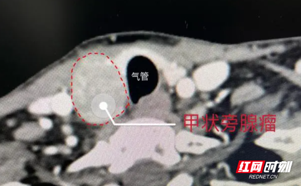 科普｜骨痛、结石、个矮？竟然是甲状旁腺瘤作怪