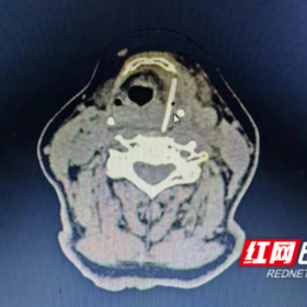 鱼刺卡喉别再喝醋吞米饭！这些方法让鱼刺安全“跑出来”