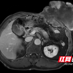 直径30cm罕见腹壁肿瘤！中南大学湘雅医院多学科联手切除