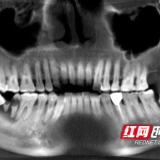 健康科普 | 智齿：口腔里的“捣蛋鬼”