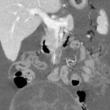 切除巨大盆腔肿瘤!这家医院妇科团队为15岁少女守护生育功能