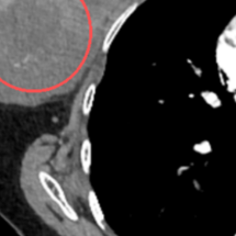 乳房小肿物三月疯长10厘米！忽视的代价敲响乳腺健康警钟