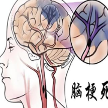 60岁大叔突发脑梗!罪魁祸首是隐藏糖尿病,这些防控技巧必看