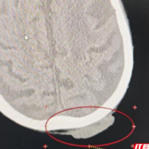 “小疙瘩”暗藏大隐患,精准放疗为九旬老人解危局