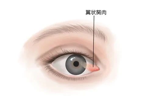 翼状胬肉.jpg