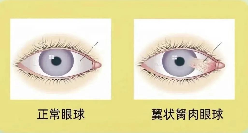 翼状胬肉2.jpg
