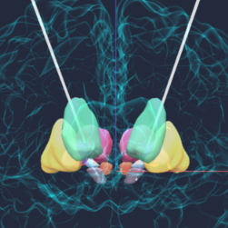 医疗服务提升年丨永州市中心医院:新技术为十年帕金森病患者按下“重启键”