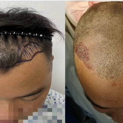 破解“头等大事” 永州市中心医院FUE毛发移植为发友重塑自信