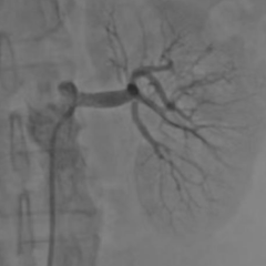 医疗服务提升年丨永州市中心医院:血压飙升220!妙手打通重度狭窄肾动脉