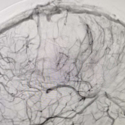 医疗服务提升年丨永州市首例上矢状窦全程血栓闭塞取栓成功 多学科联手救治危重患者
