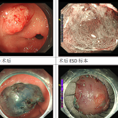 医疗服务提升年丨永州市中心医院消化内科ESD技术破解特殊病例难题