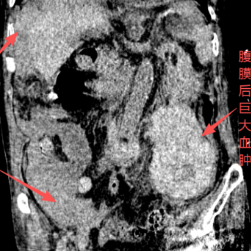 医疗服务提升年丨永州市中心医院成功救治罕见腹膜后血管畸形破裂患者