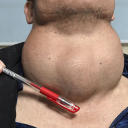 医疗服务提升年丨永州市中心医院成功拆除高危甲状腺巨大肿瘤“定时炸弹”