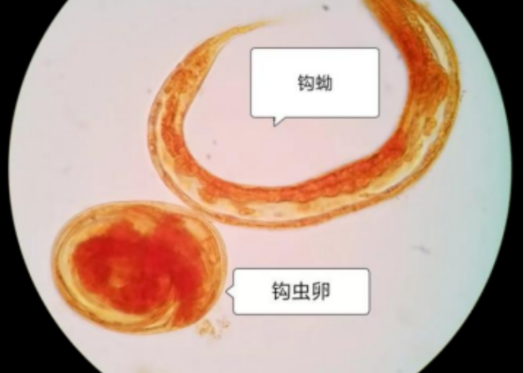 老人贫血20余年，竟是因为这种“钩”在肠壁上的虫子1457.png