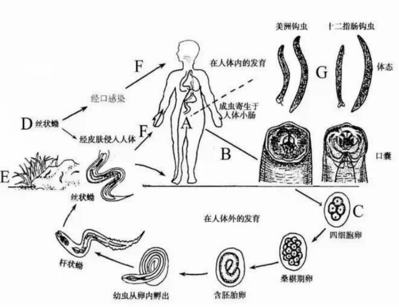 老人贫血20余年，竟是因为这种“钩”在肠壁上的虫子1054.png
