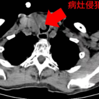 邵阳学院附属第一医院：超越“腺”制，鏖战晚期甲状腺癌