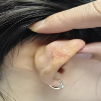 电子线放疗 瘢痕疙瘩的“无创消融术”