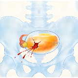 腹痛硬扛险送命！22岁女子黄体破裂腹腔积血，妇科急症需警惕