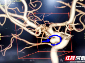 隆回：女子颅内动脉瘤出血头痛如裂 介入手术成功栓塞保平安
