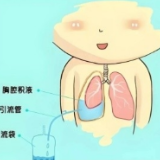 邵阳市第二人民医院：“胸腔积液”不容小觑 当心“脓胸”