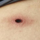 郴州市第四人民医院成功救治一例重症恙虫病合并ARDS患者