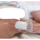 精准穿刺筑通路,用心守护早到天使——怀化市鹤城区人民医院成功为高危早产儿实施股静脉PICC置管术