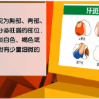【健康与生活】高温天出汗多 当心花斑癣“上身”