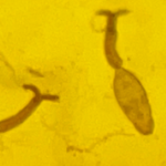 接触10秒即可感染!一旦出现这些症状,立即就医