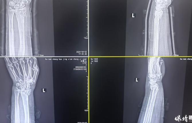 保靖县中医院：杏林正骨显身手 骨折复位不开刀