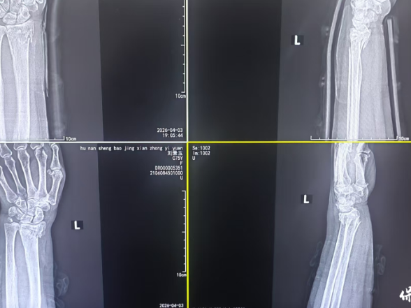 保靖县中医院：杏林正骨显身手 骨折复位不开刀